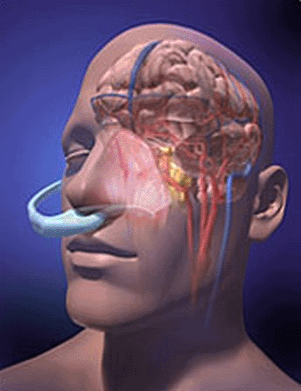 Image: The RhinoChill Intra-Nasal Cooling System (photo courtesy BeneChill).